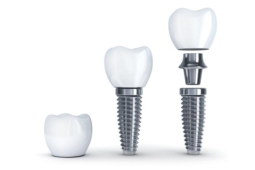 zęby implanty