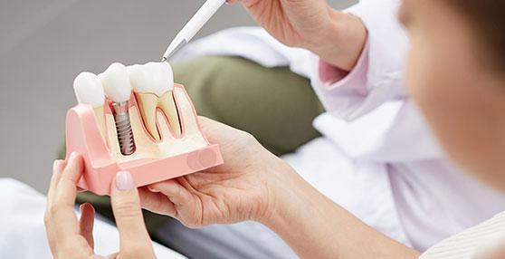 dłonie implanty zęba